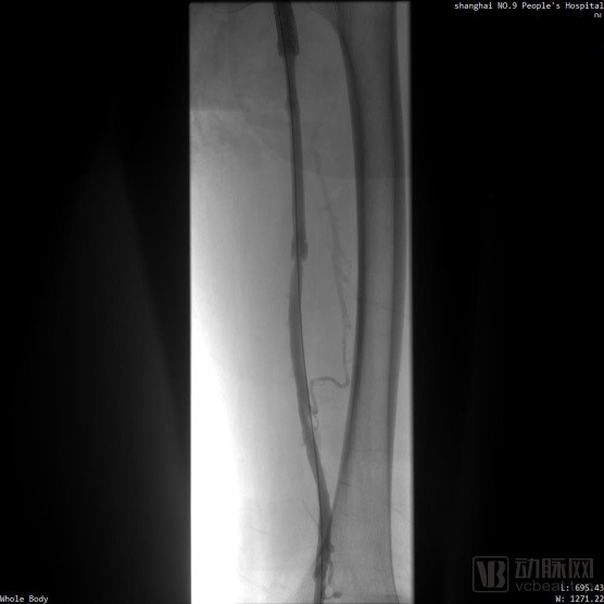 中国医院血栓清除技术,血栓消除的高端技术
