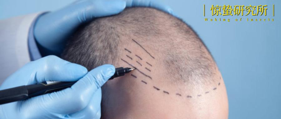 植发生意究竟有多暴利,植发暴不暴利