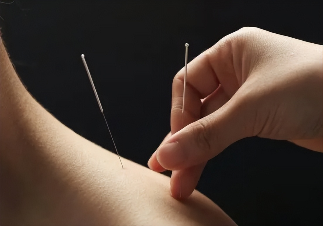 中风并发症会增加病死率，中医特色疗法针灸治疗效果如何？