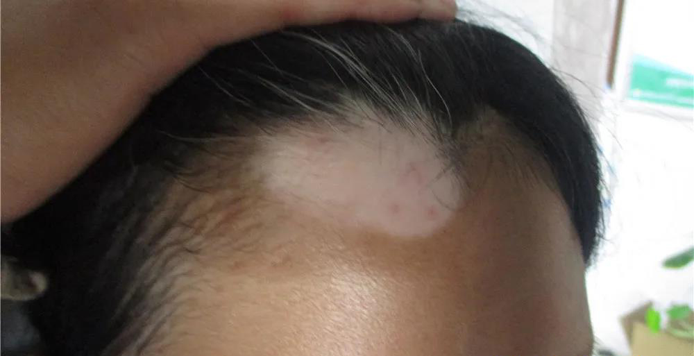 头部白癜风白发能治愈吗,头部白癜风治疗后反而扩散