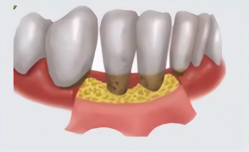 牙周炎犯了不治疗自己会自愈吗,得了牙周炎暂时不能去医院怎么办