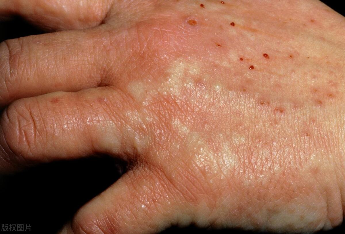 湿气重长湿疹怎么调理夏天特别痒,湿气重长湿疹怎么调理