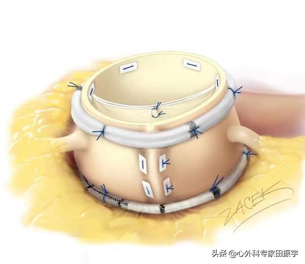 最先进的主动脉瓣二瓣叶畸形修复术（2020版）