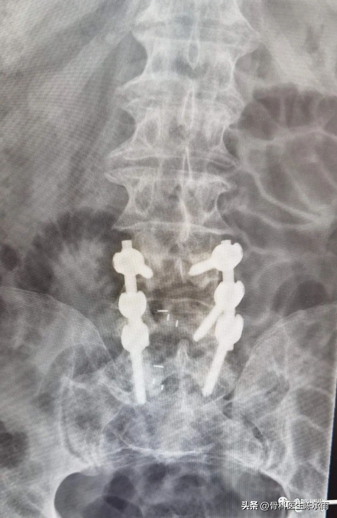 腰椎滑脱椎管狭窄手术后遗症,腰椎间盘突出椎管狭窄的手术