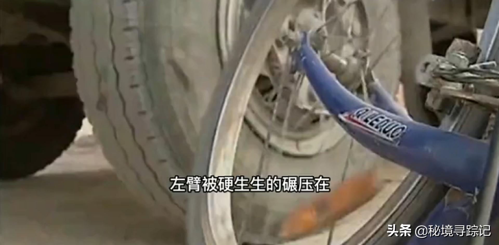 儿童胳膊断了做手术,小孩手臂断了真实手术