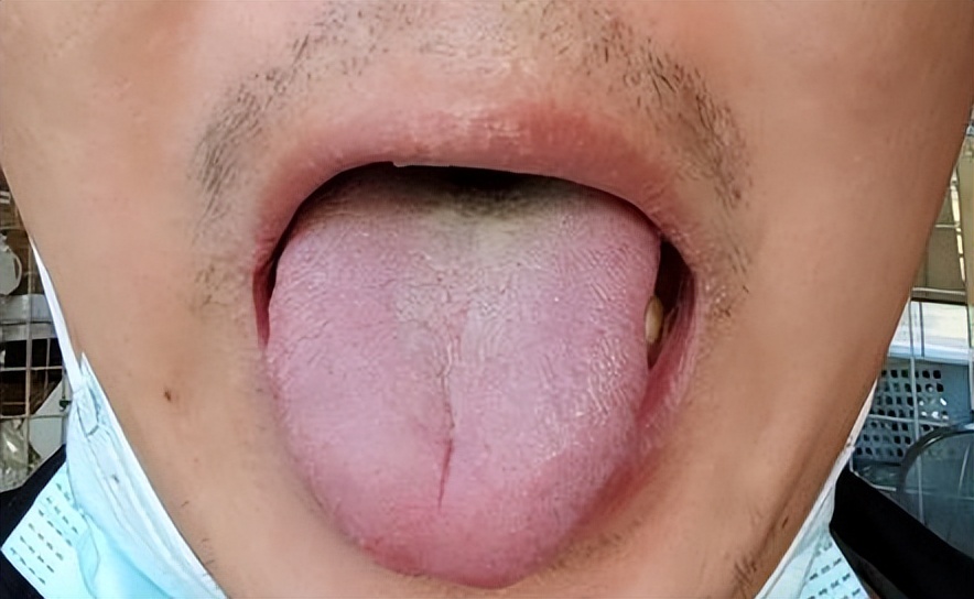 舌中凹陷有裂纹怎么回事,舌中部凹陷裂纹中医代表什么