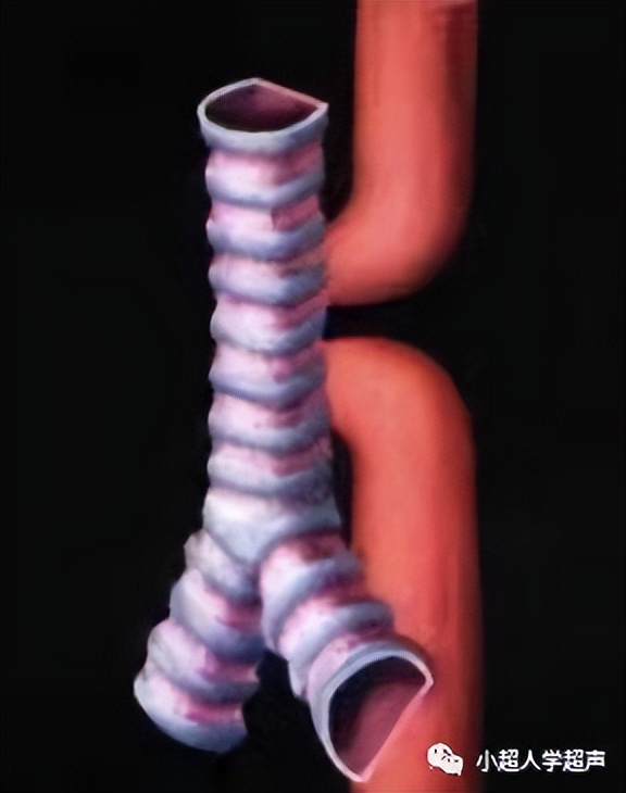 食道闭锁超声表现,食管闭锁一型手术过程