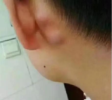 小孩脖子淋巴结有疙瘩一直存在,淋巴结发炎脖子上有疙瘩怎么办