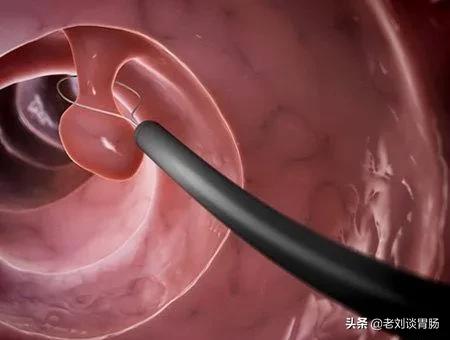肠镜检查出直肠息肉怎么办,做肠镜发现肠息肉怎么办