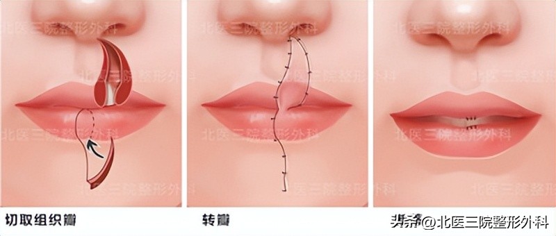 上嘴唇缺一块怎么修补,上嘴唇缺损