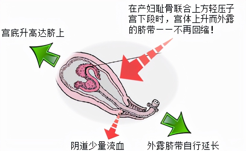 孕妈妈怎么判断胎位是正的,胎儿屁股在右侧是什么胎位