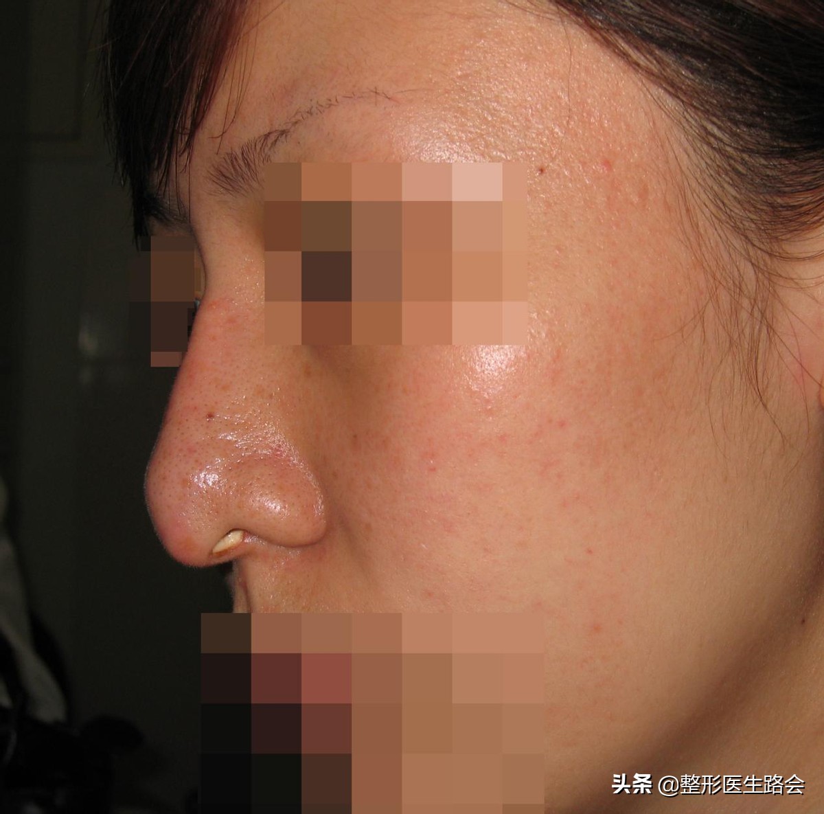 硅胶隆鼻5年歪了怎么修复,隆鼻10天歪了可以矫正吗