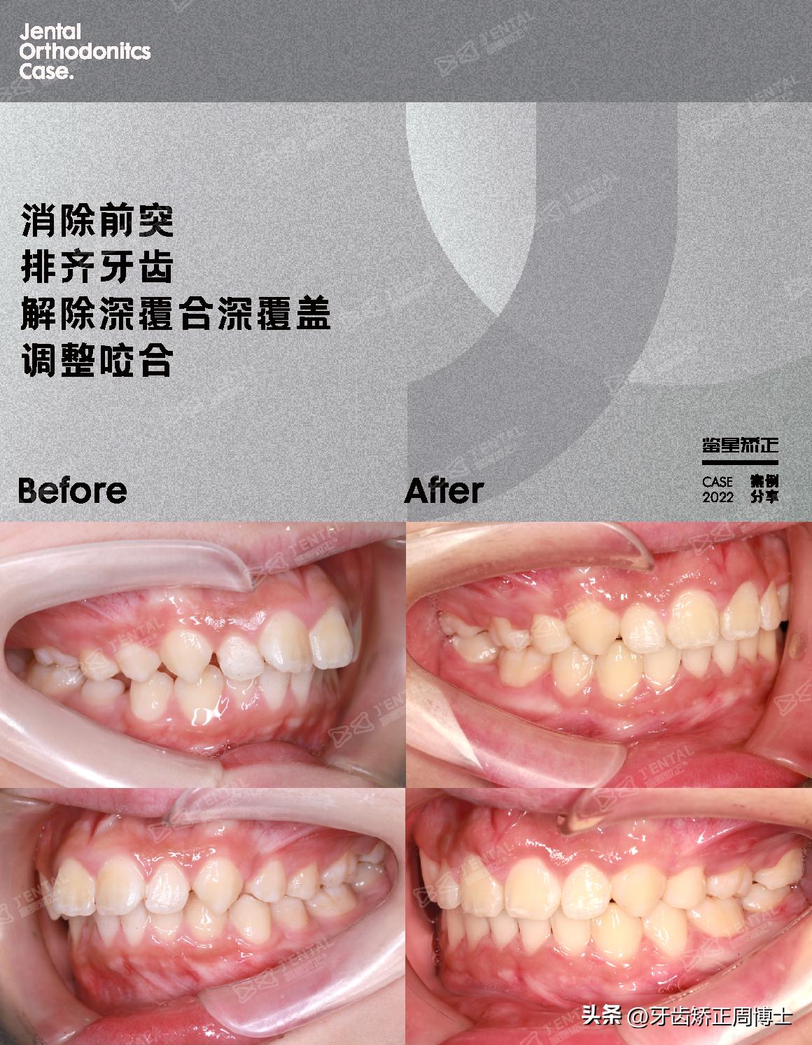 mrc戴上后不能闭上嘴怎么办,mrc矫正能用到几岁