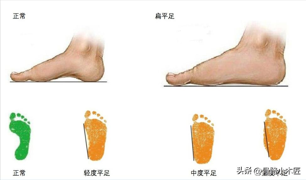 平足症疼痛的位置在哪,平足症