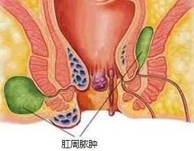 肛周脓肿手术后可以喝酒吗,肛周脓肿术后可以喝酒吗