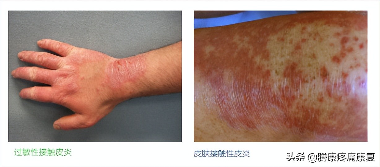 增生性瘢痕和瘢痕疙瘩的鉴别诊断,皮质类固醇贴