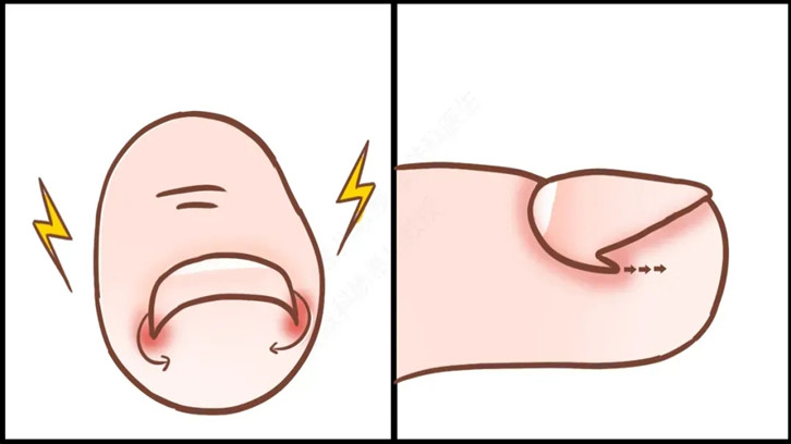 脚趾甲老往肉里钻，一碰还疼？教你小妙招，预防甲沟炎告别疼痛