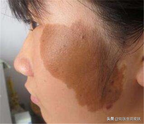 长这种斑小心是癌症信号,哪几种斑容易成癌