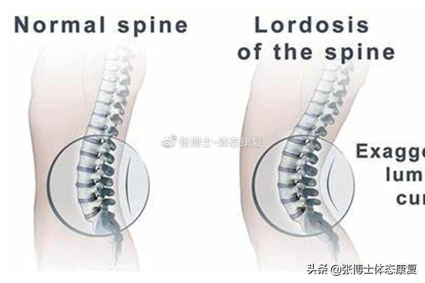 「体态康复」缓解下背痛的十六条建议