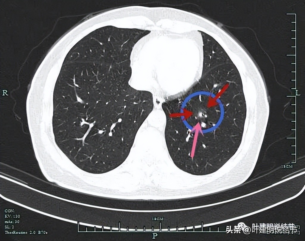 成立肺癌诊疗一体化中心,构建肺癌精准诊疗生态圈