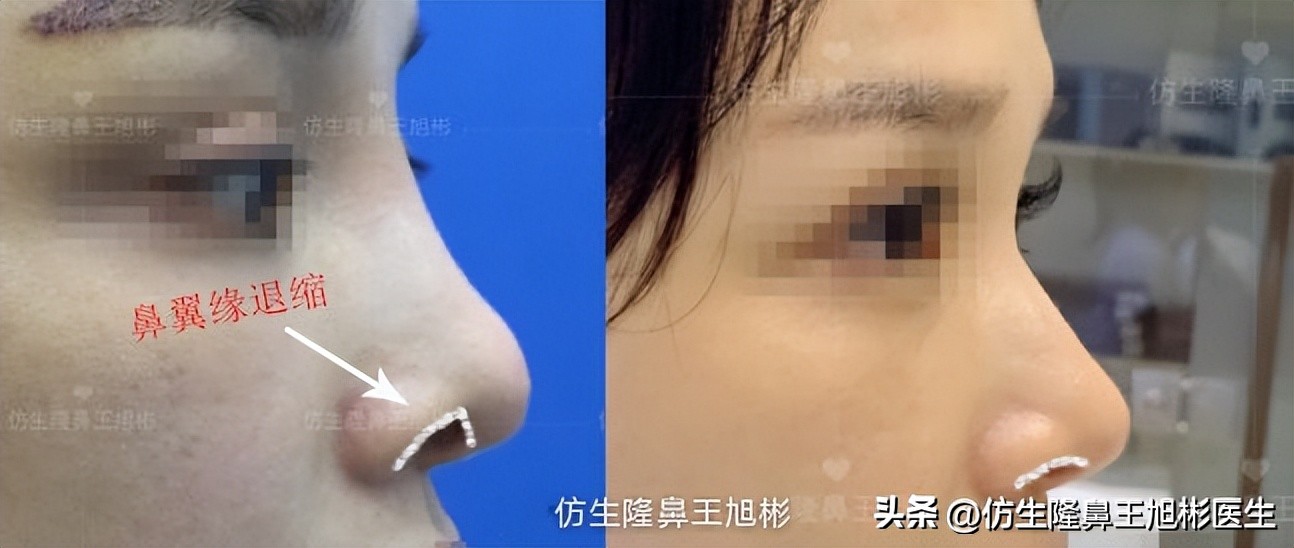 隆鼻的鼻翼怎么修复,隆鼻后多久可以做鼻翼缘矫正