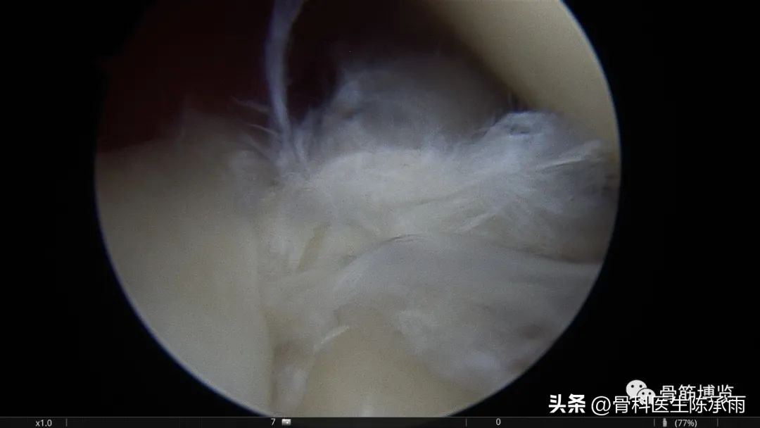 肱二头肌长头肌腱断裂超声报告,上臂肱二头肌