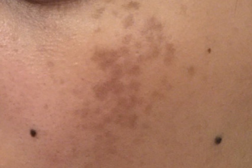 常年吃药造成脸上有斑怎么治,怎么判断脸上黑点是痣还是斑