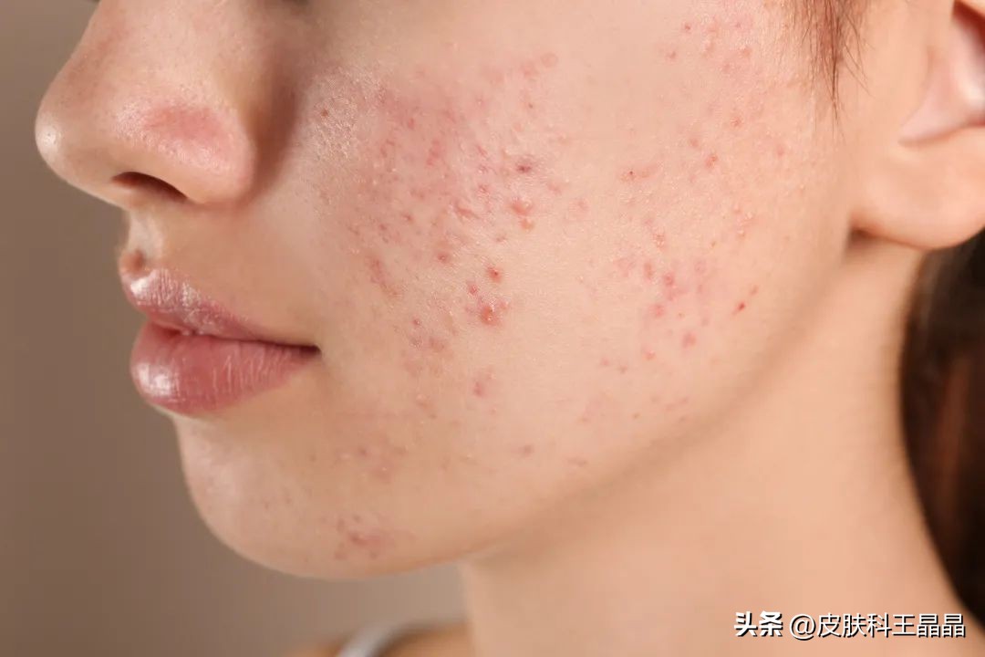 战痘分享如何有效祛痘印,战痘多年不见效果