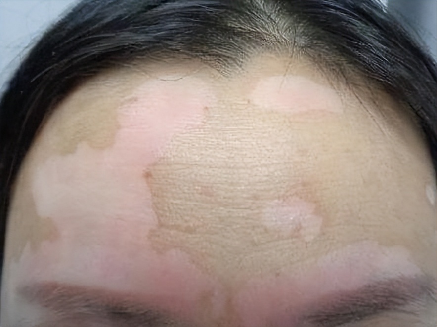 真菌清热除湿的口服中成药,细菌性皮肤病的常用药