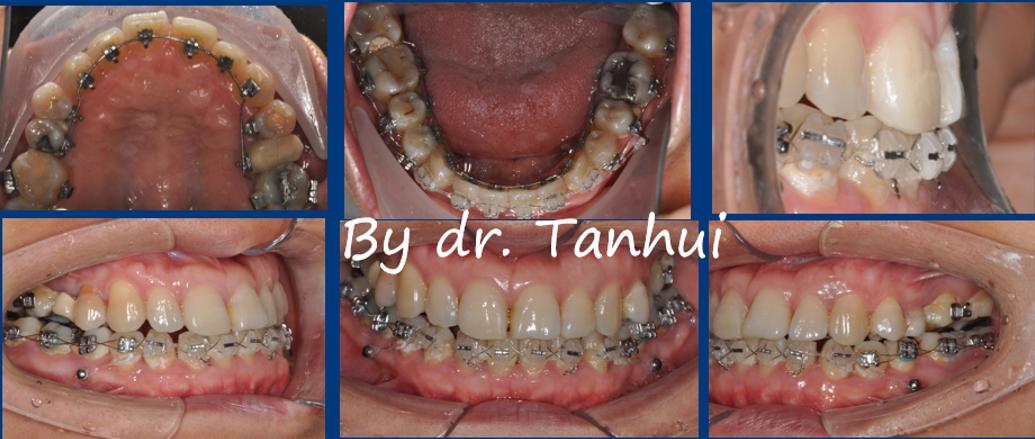 地包天能做手术矫正吗,儿童地包天矫正几岁做最好