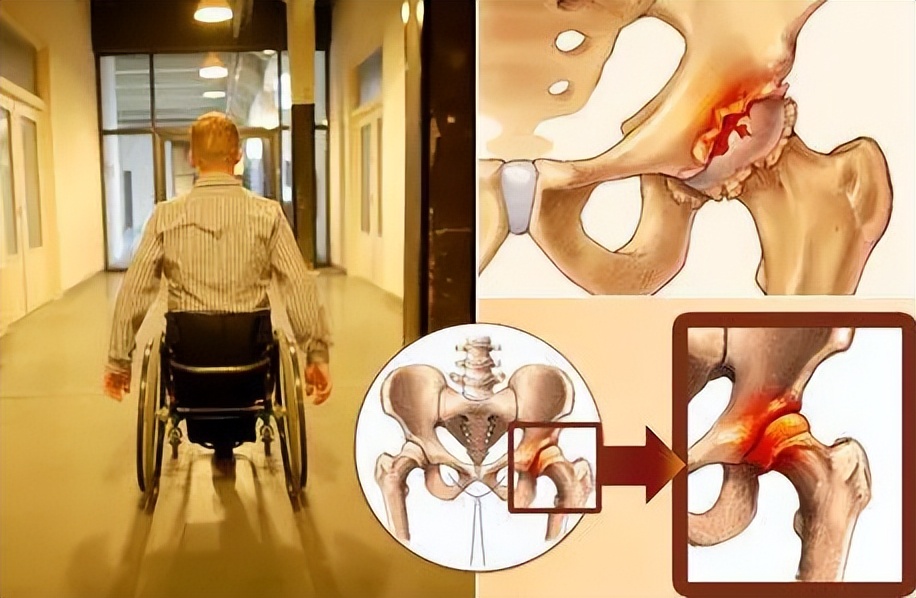 33岁酗酒20年，喝出了股骨头坏死，怎么办？中医这一方可以治！