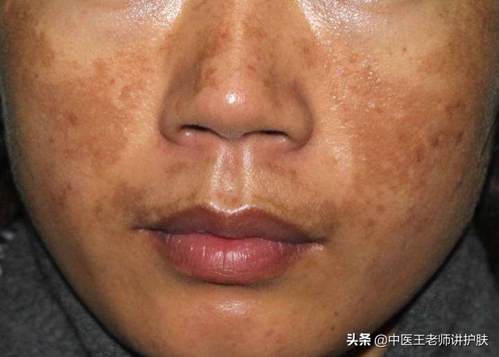 什么药能祛斑脸色暗黄,有什么方子能去暗黄