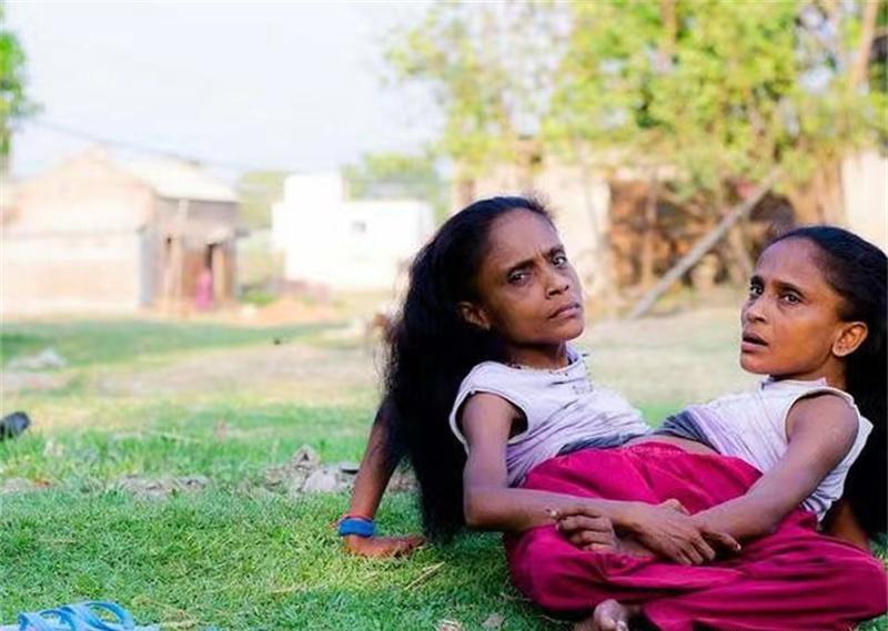 印度连体姐妹嫁给男子,印度男娶连体姐妹