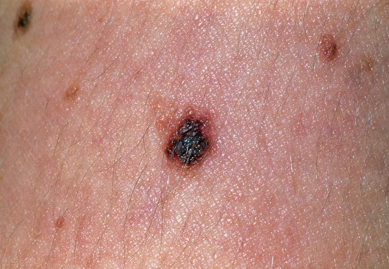 黑斑上长黑痣是不是有癌细胞,身上长黑痣越来越多会是癌细胞吗