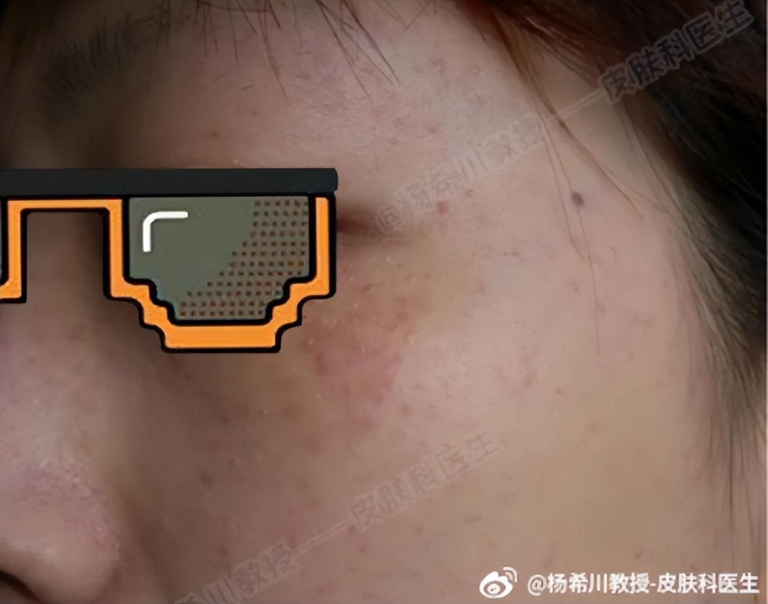 老公身上有吻痕可作为出轨证据吗,吻痕是出轨证据吗