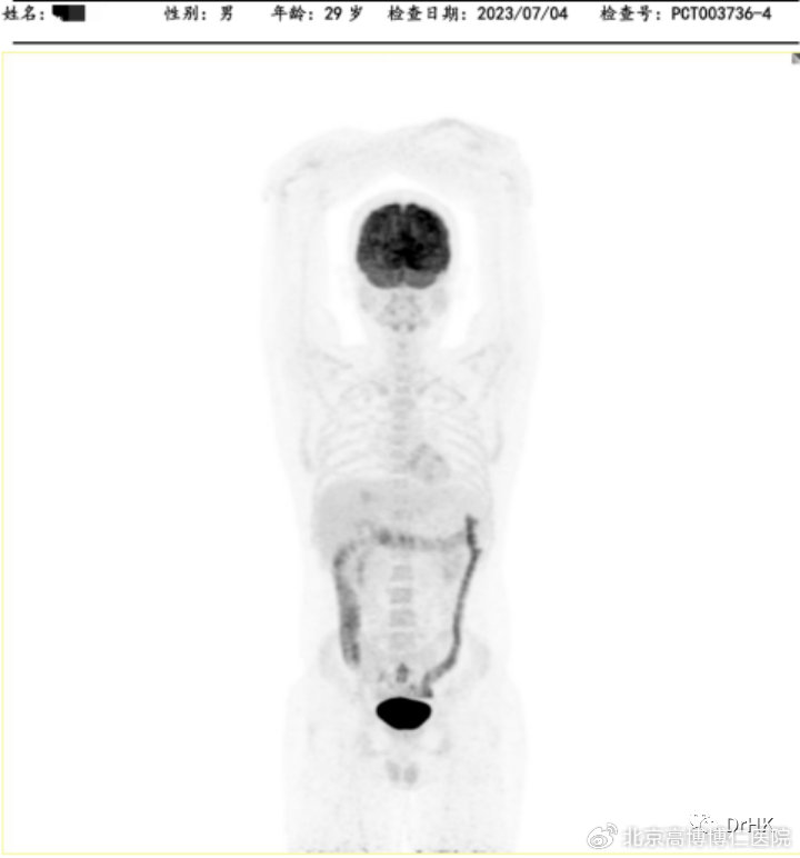 cart治疗淋巴瘤失败会怎样,car-t治疗晚期淋巴瘤的成功率