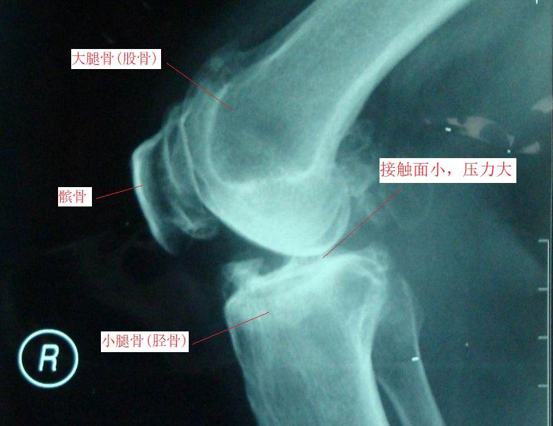 抬腿上楼梯时膝关节疼是怎么回事,上下楼梯膝关节疼痛是怎么回事