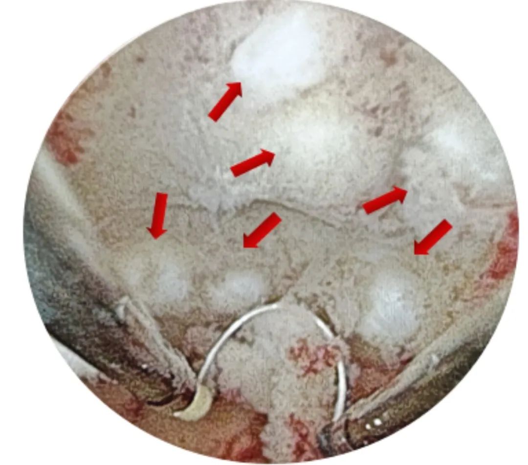 宫腔镜摘除子宫肌瘤,微创宫腔镜子宫肌瘤