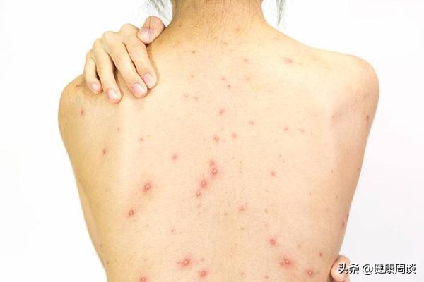 毛囊炎引起的痘痘一般长在哪里,毛囊炎红色的痘痘怎么消除