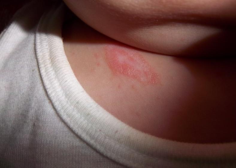 坑人！药浴中心用滚药包给孩子治皮肤，孩子昏迷4天，后果可怕