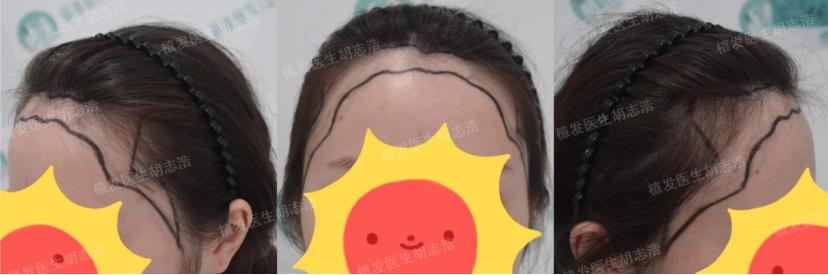 植发后后枕部的头发多久能恢复,植发3个月恢复图片