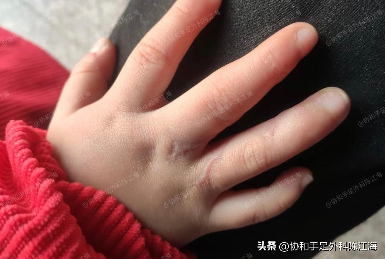 小孩多指并指免植皮新技术,儿童并指零植皮新方法
