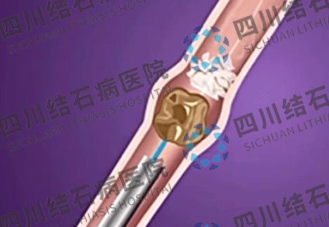 怎么样减少肾结石的发生,肾结石怎么控制最有效