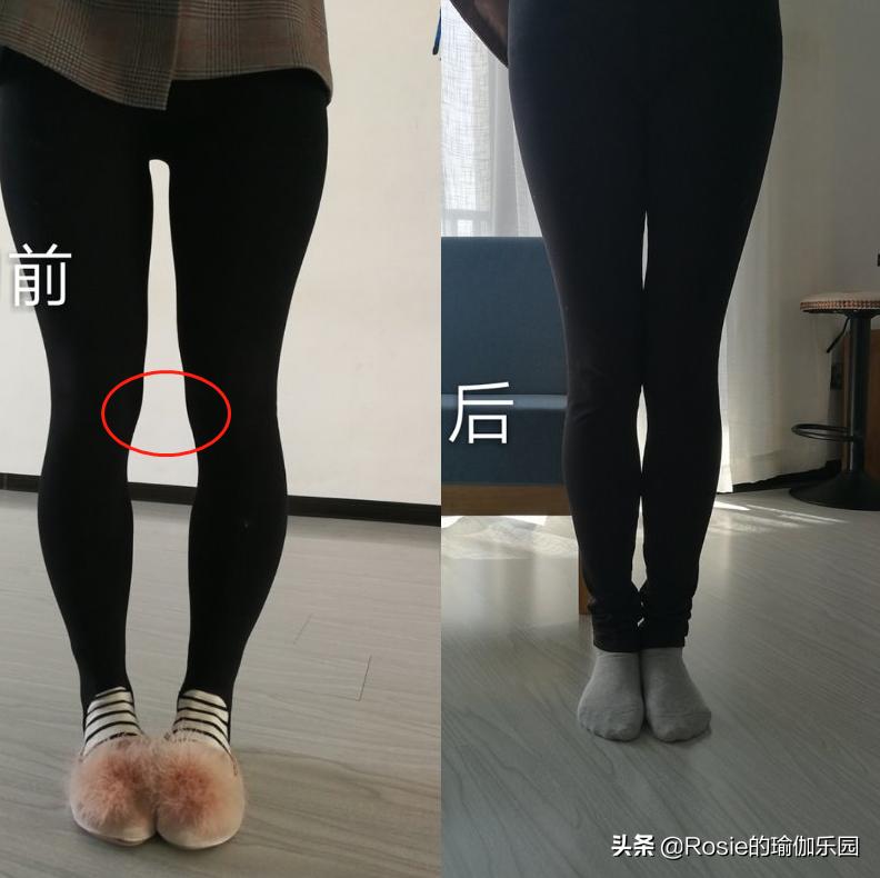 膝盖内侧鼓包怎么快速变直,膝盖外翻内侧鼓包如何消除