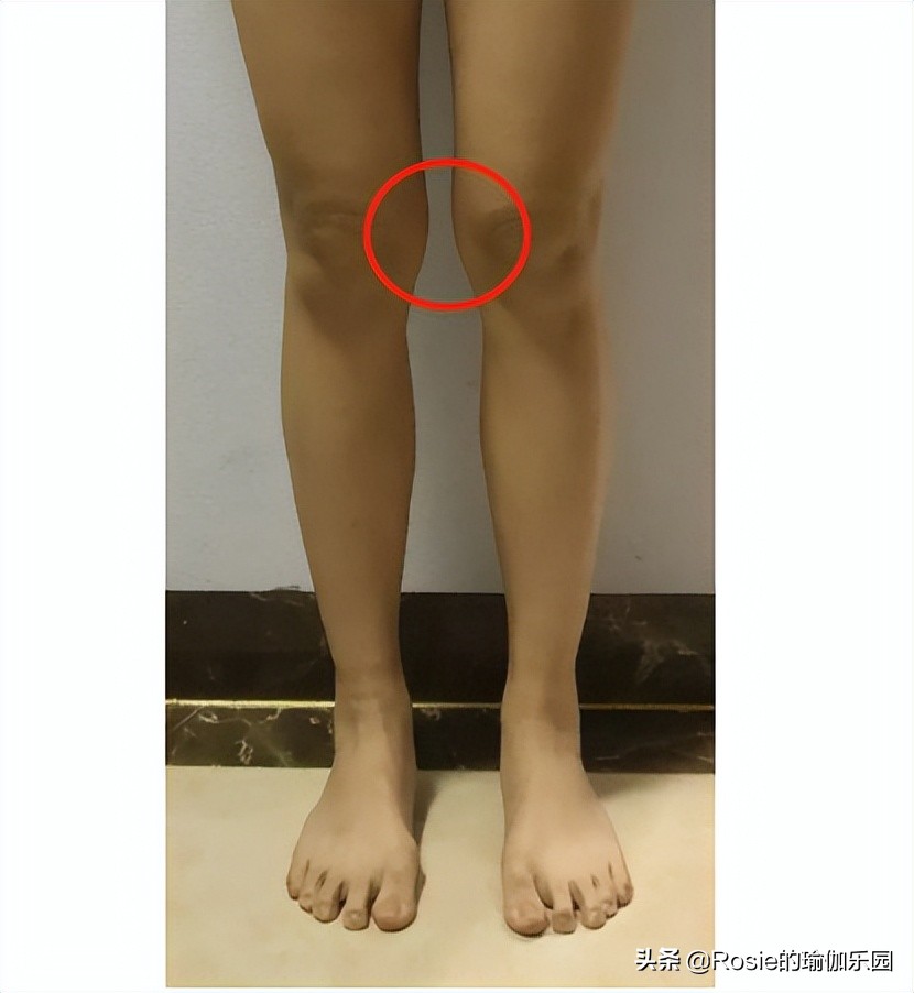 膝盖内侧鼓包怎么快速变直,膝盖外翻内侧鼓包如何消除