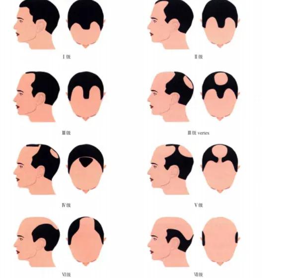 头顶漩涡处头发稀少怎么办,15岁头顶漩涡处头发稀少