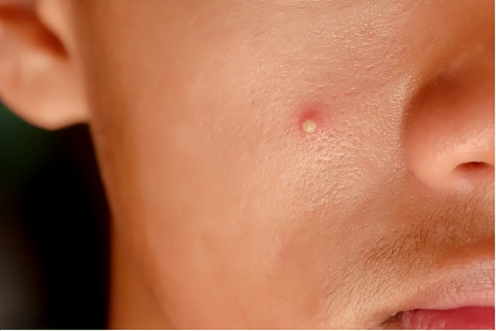 长青春痘了该如何把青春痘消掉,长青春痘的原因及解决方法