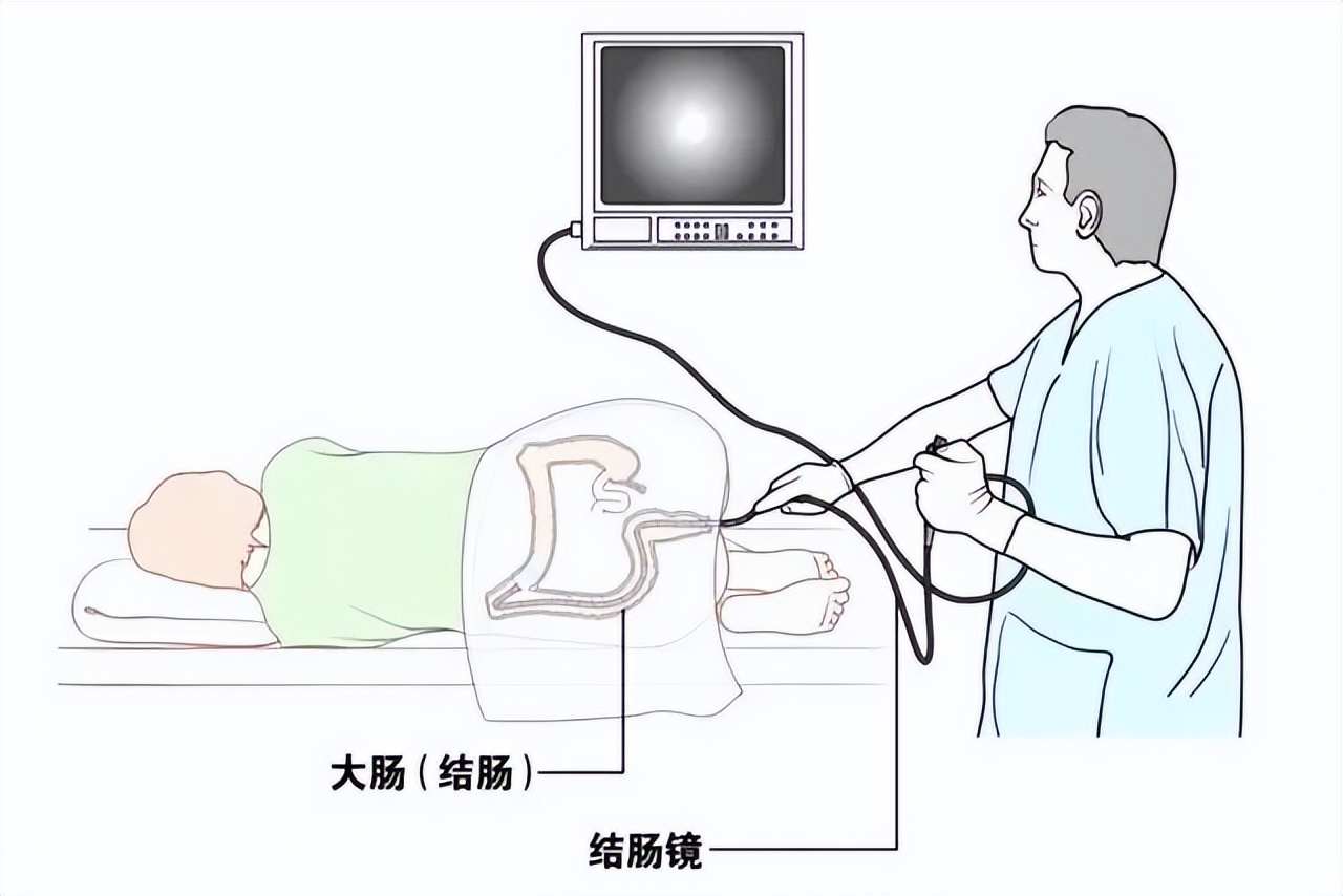 胃肠镜检查五问看完你就懂了,胃肠镜检查的适应症和注意事项