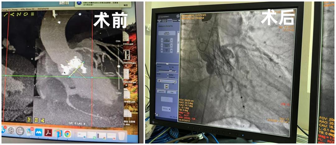心脏主动脉瓣置换术后15年心绞痛,升主动脉血管及心脏瓣膜置换手术