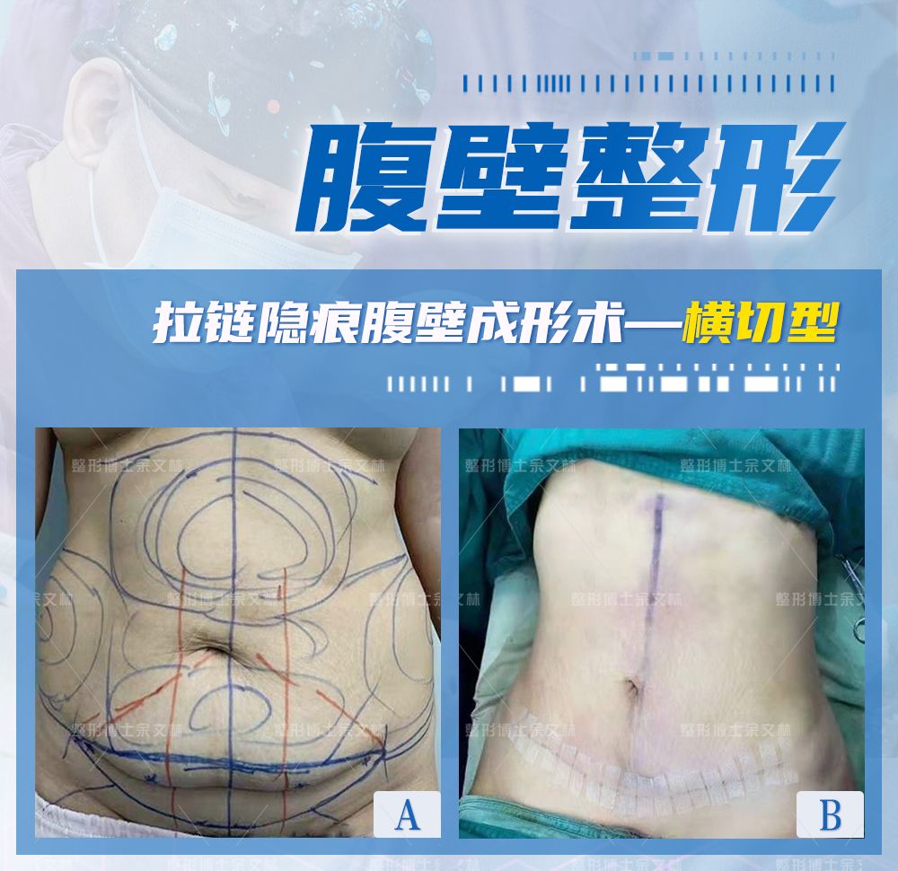 腹部松弛的女性是生过小孩的吗,腹壁松弛是因为肚子太大吗